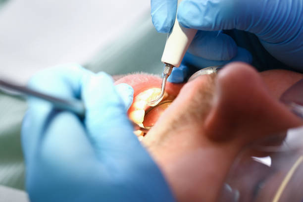 Best Emergency Tooth Extraction in Elverta, CA